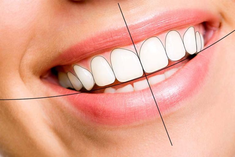 اصلاح طرح لبخند