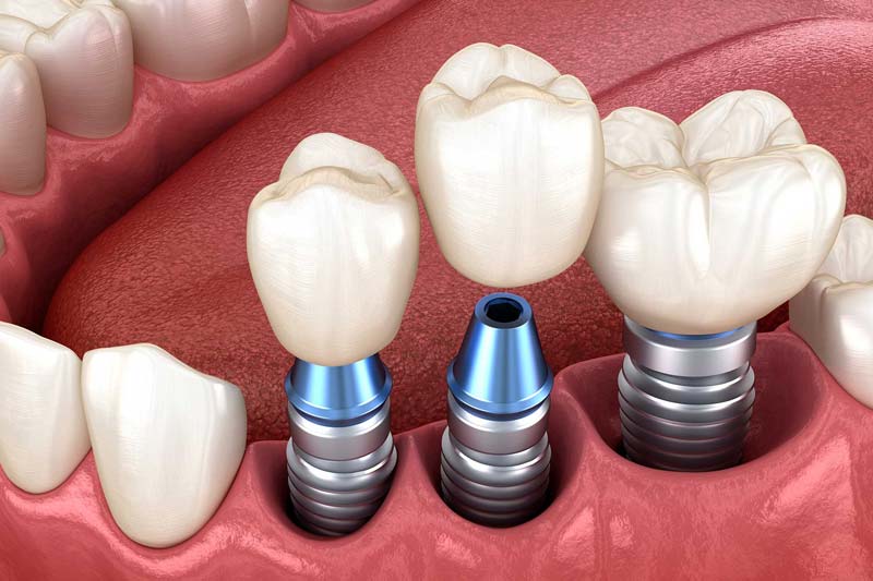 انواع ایمپلنت دیو کدام اند؟ ویژگی های هر کدام چیست؟