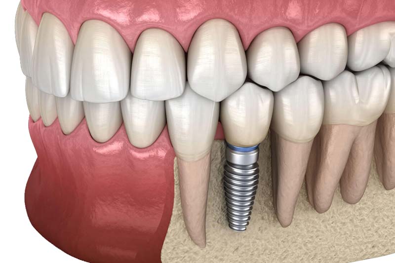 ایمپلنت icx چه ویژگی هایی دارد؟