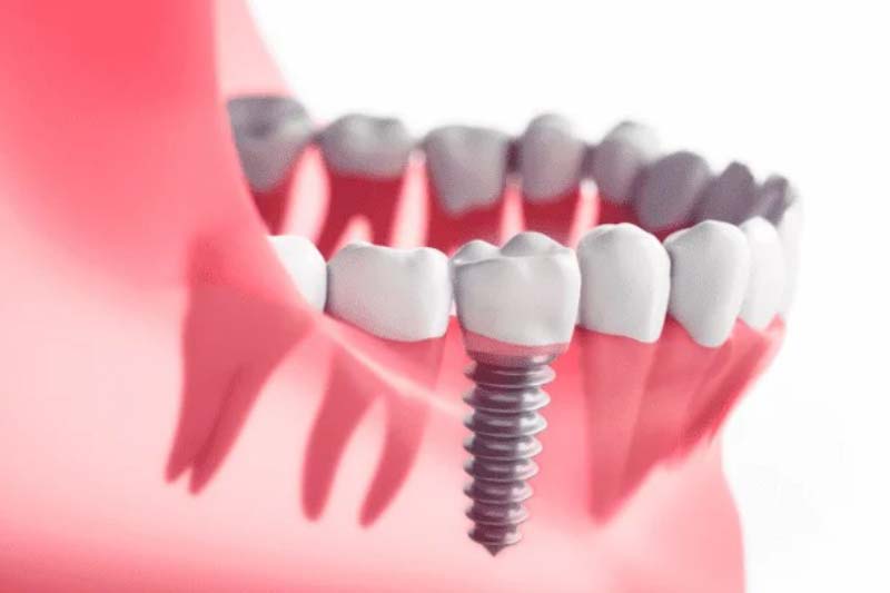 ایمپلنت اشترومن Neodent چه ویژگی هایی دارد؟