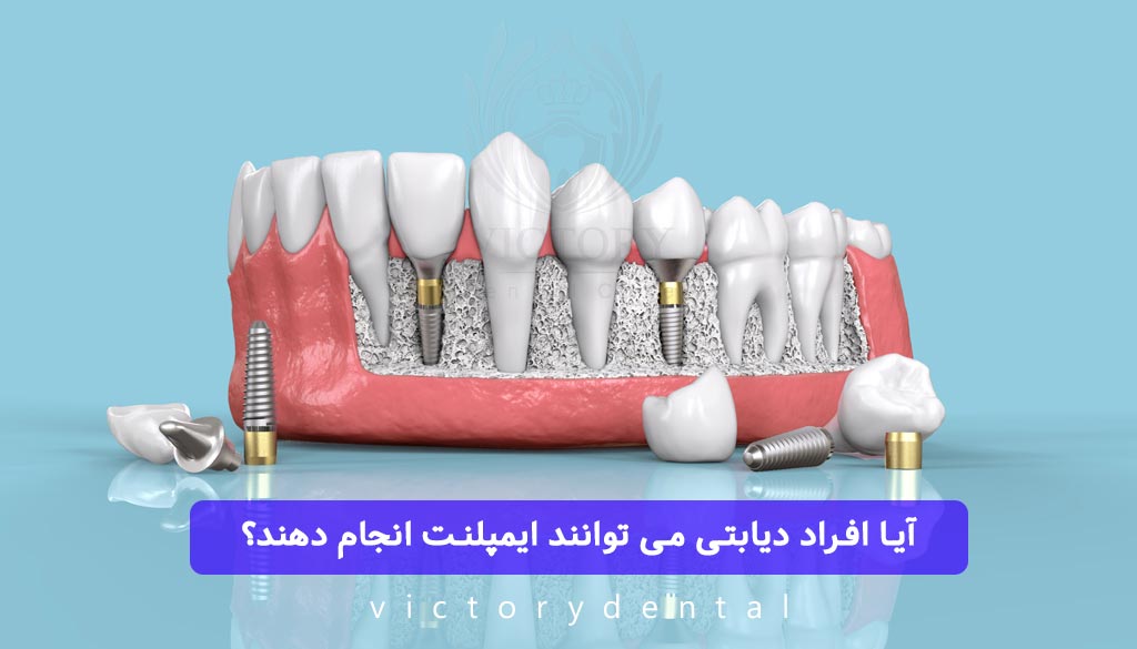 ایمپلنت برای افراد دیابتی