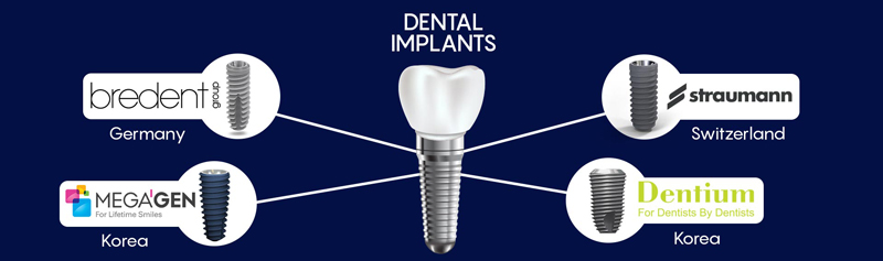 ایمپلنت دندان کره ای