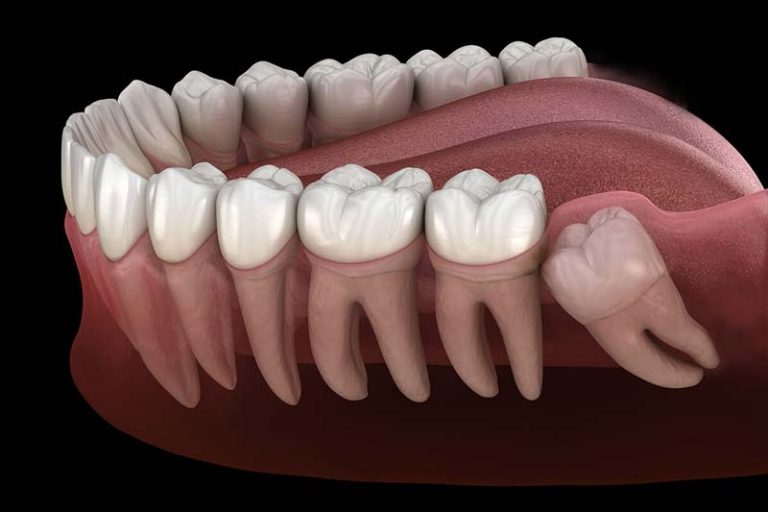 بعد از جراحی دندان عقل چه بخوریم؟