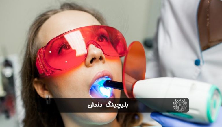 بلیچینگ دندان