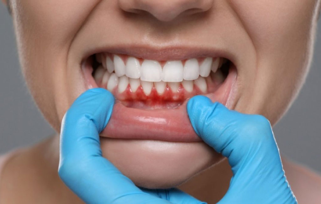 راهکارهای پیشگیری از خونریزی لثه