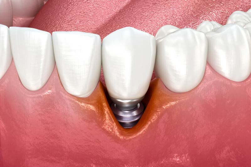 شرایط کاشت ایمپلنت bego چیست؟