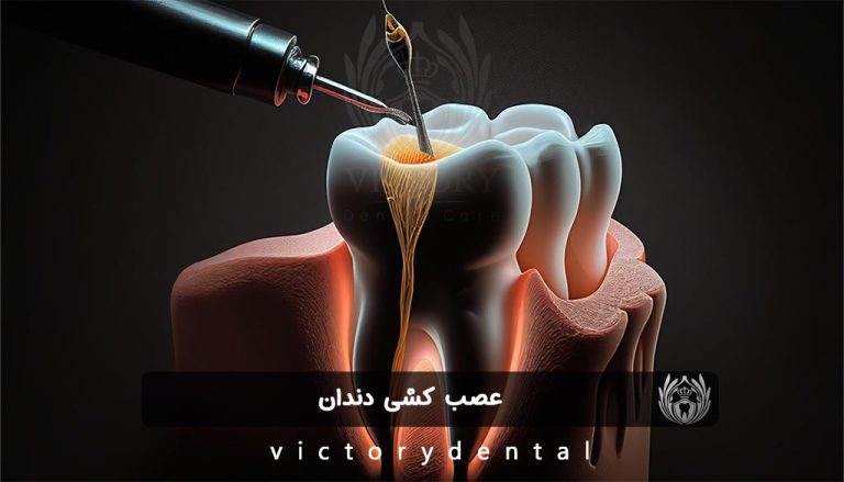 عصب کشی دندان در خیابان فرشته