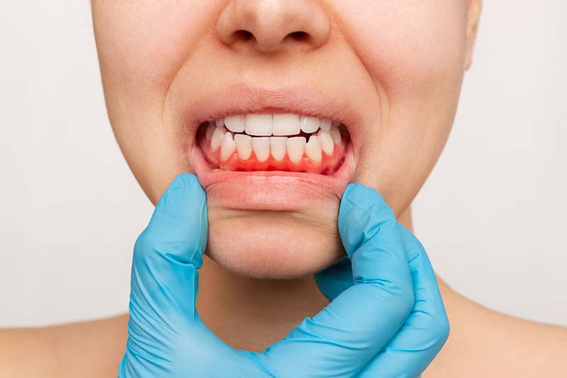 عفونت لثه چه علایمی دارد؟