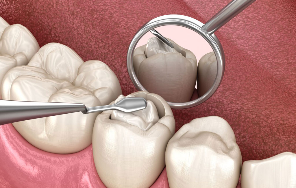مراقبت از آمالگام سخت تر است یا کامپوزیت؟