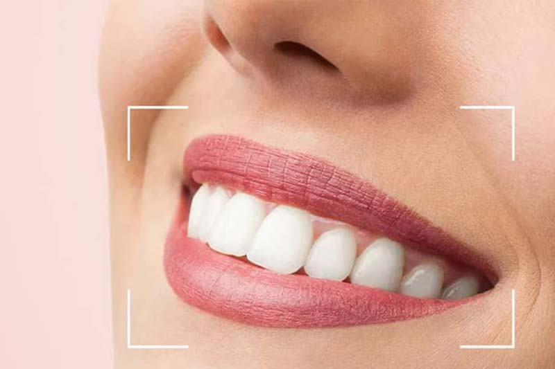 مراقبت های بعد از اصلاح طرح لبخند چیست؟