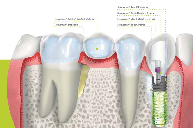 مزایا ایمپلنت اشترومن Roxolid چیست؟