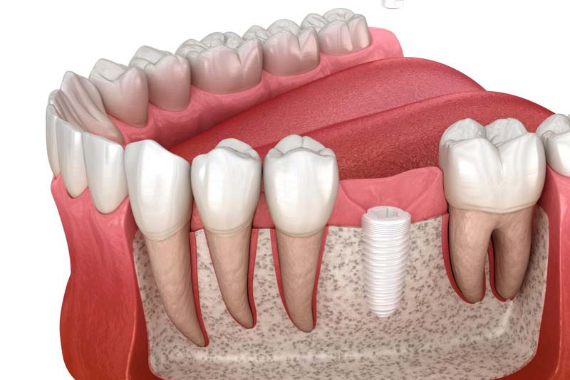 مزایا روکش زیر کونیا چیست؟