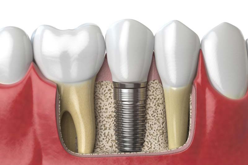 مزایا و معایب ایمپلنت فوری دندان چیست؟