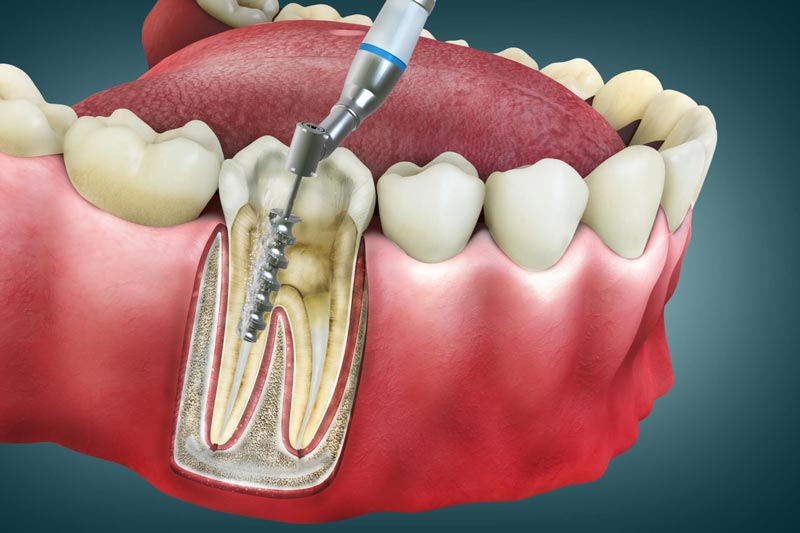 ویژگی ها و مراحل عصب کشی دندان چیست؟