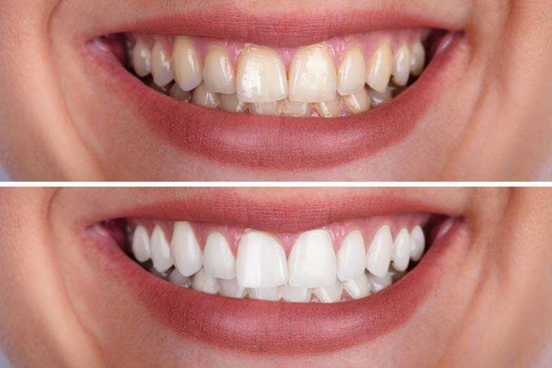 چرا بلیچینگ دندان در الهیه تهران را انتخاب کنیم؟