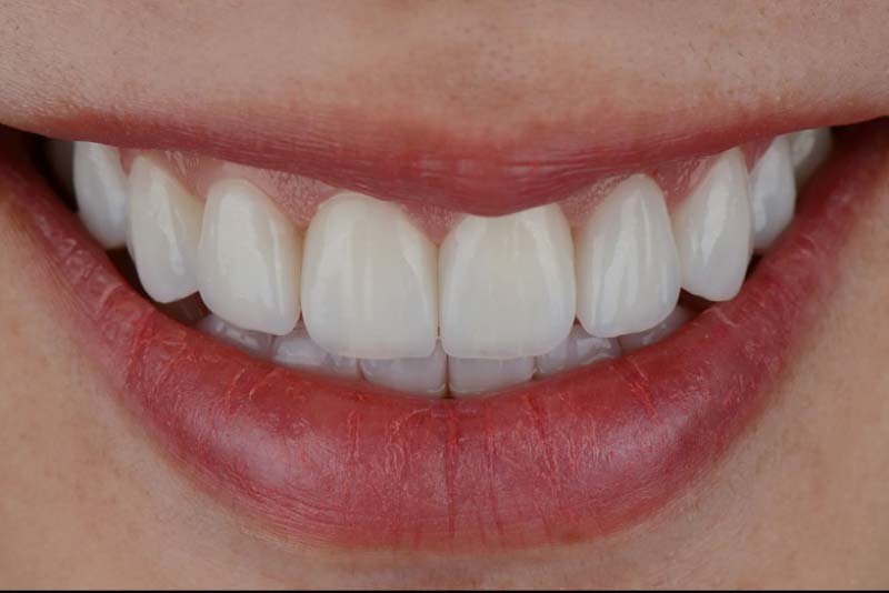 چگونه از تغییر رنگ روکش دندان جلوگیری کنیم؟
