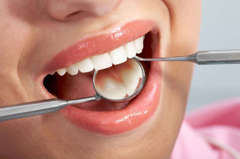 کامپوزیت ونیر برای اصلاح طرح لبخند