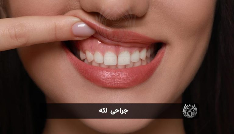 جراحی لثه