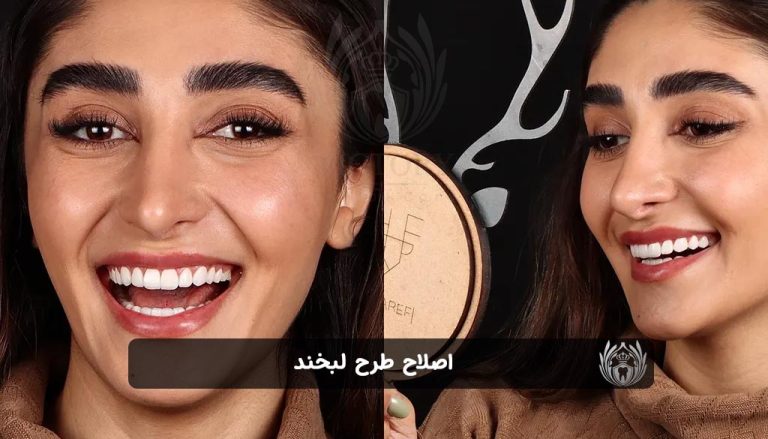 اصلاح طرح لبخند
