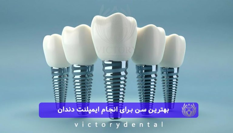 بهترین سن برای انجام ایمپلنت دندان