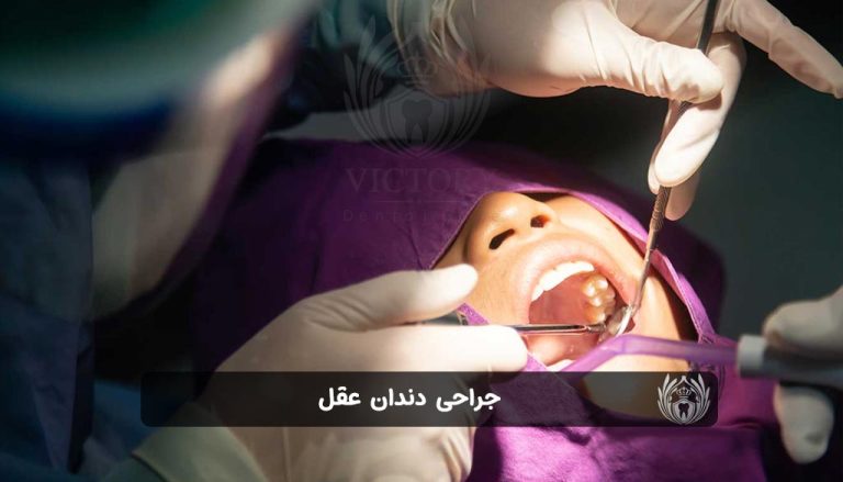 جراحی دندان عقل