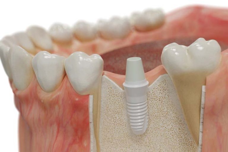 روکش تمام سرامیک زیرکونیا چه ویژگی‌هایی دارد؟