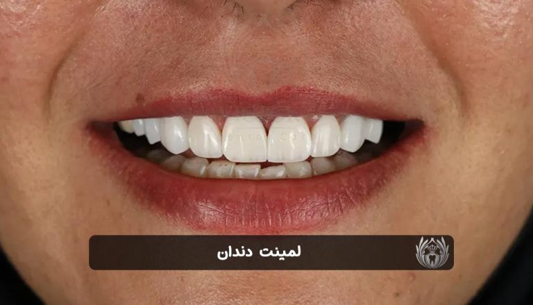 لمینت دندان