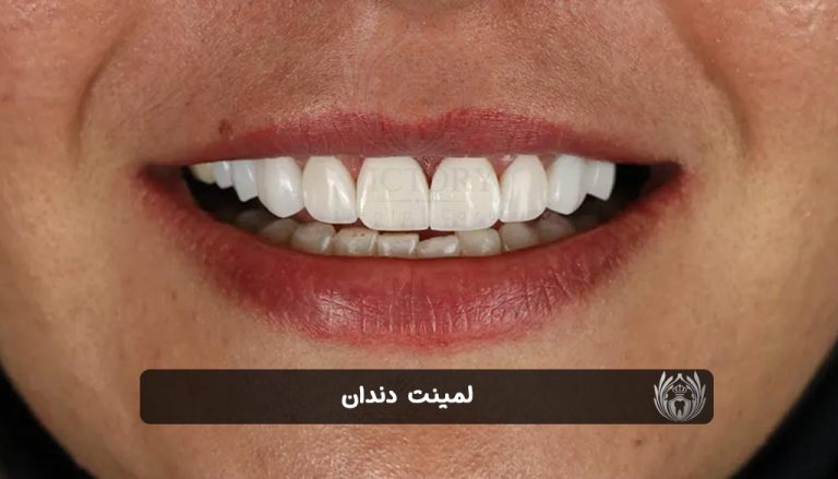 لمینت دندان