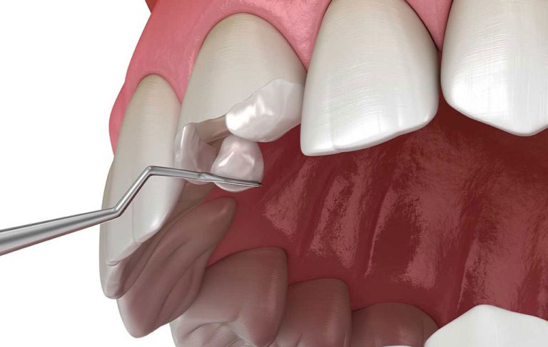 پر کردن دندان جلو