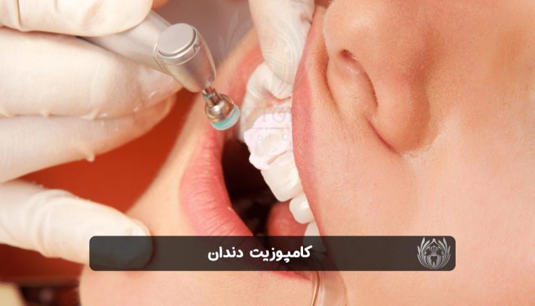 کامپوزیت دندان